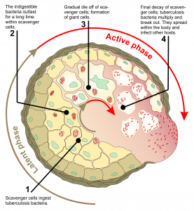 Tuberkelbildung und -zerfall
